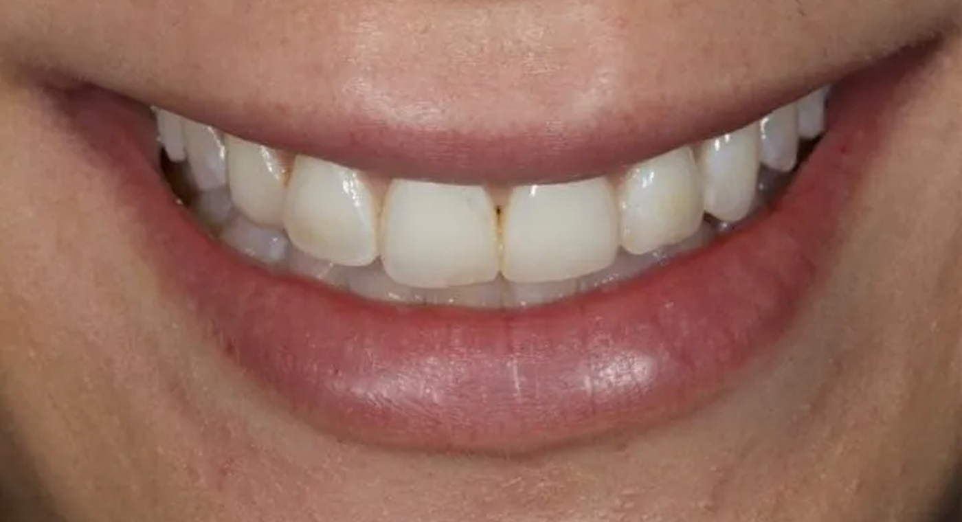 image before